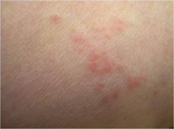Bed Bug Symptoms Pictures and Signs