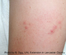 Picture Bed Bug BitesWith Swelling