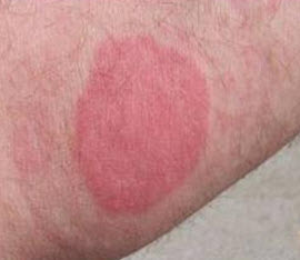 Steroid treatment for bed bug bites
