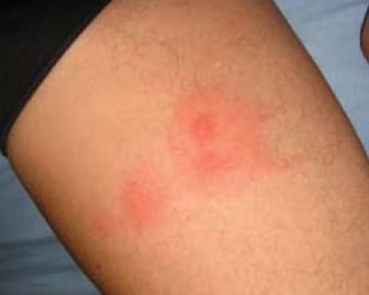 photo bed bugs bites on arm