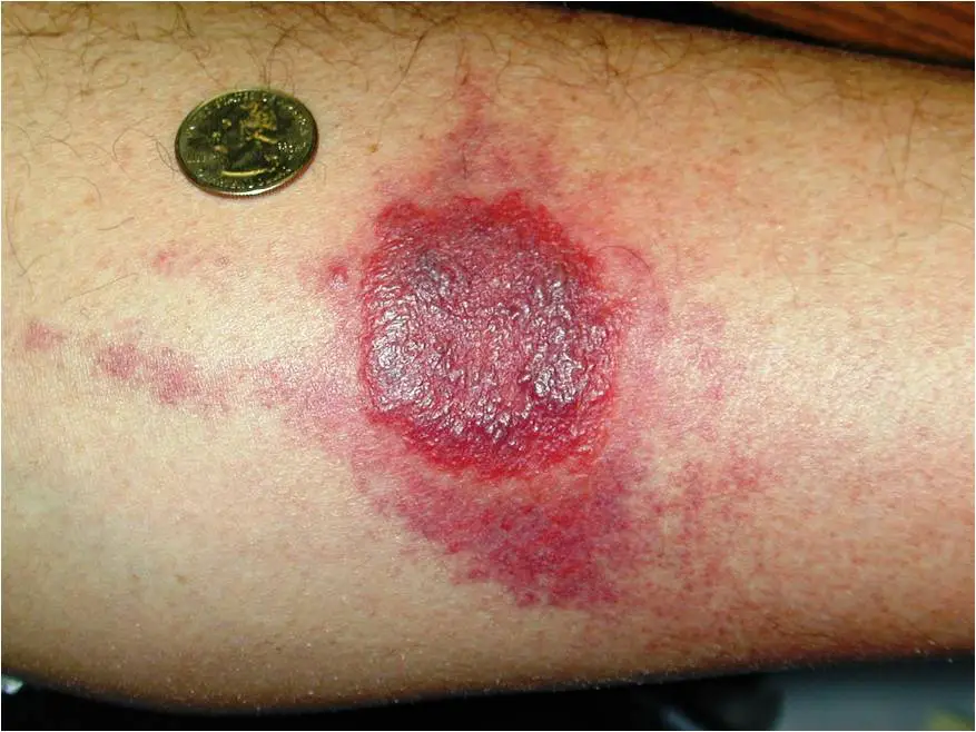 Bed Bug Symptoms: Pictures, When They Appear and Treatment