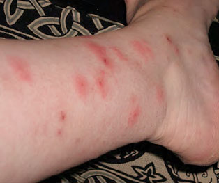 How to Treat Red Bumps on Arms Naturally - The Greenbacks Gal