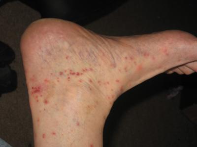Bed Bug Bites on Foot