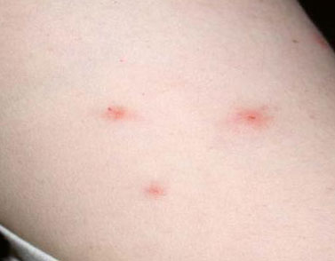 Picture of Bed Bug Bite: Early and Late Stage Examples
