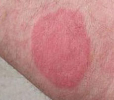 Bed Bug bite wheal skin reaction