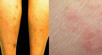 Flea Bites Picture on Left vs. Bed Bug Bite Picture on Right. Note how the flea bites are all red while bed bug bites have a clear or different color center.