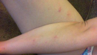 Picture Bed Bug Bites on Arms and Legs