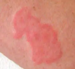 What does bed bug rash look like?