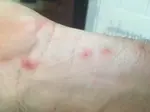 bites, what do you think this is