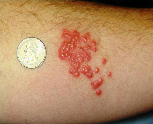 Bed Bug Signs, Symptoms, and Treatment