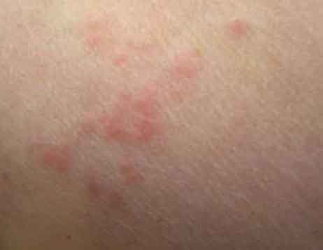 bed bug bites 1 hour after being bitten