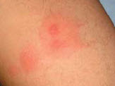 Bed bug bites on an arm