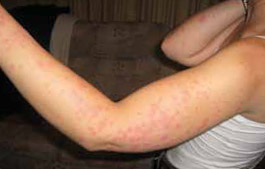 bed bug bites 4 days after exposure to bed bugs