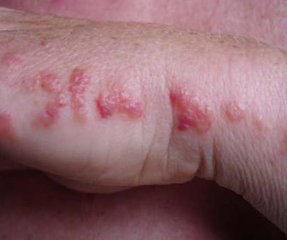 chronic bed bug bite marks on arm