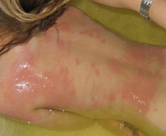 erythema skin reaction from scratching bed bug bites
