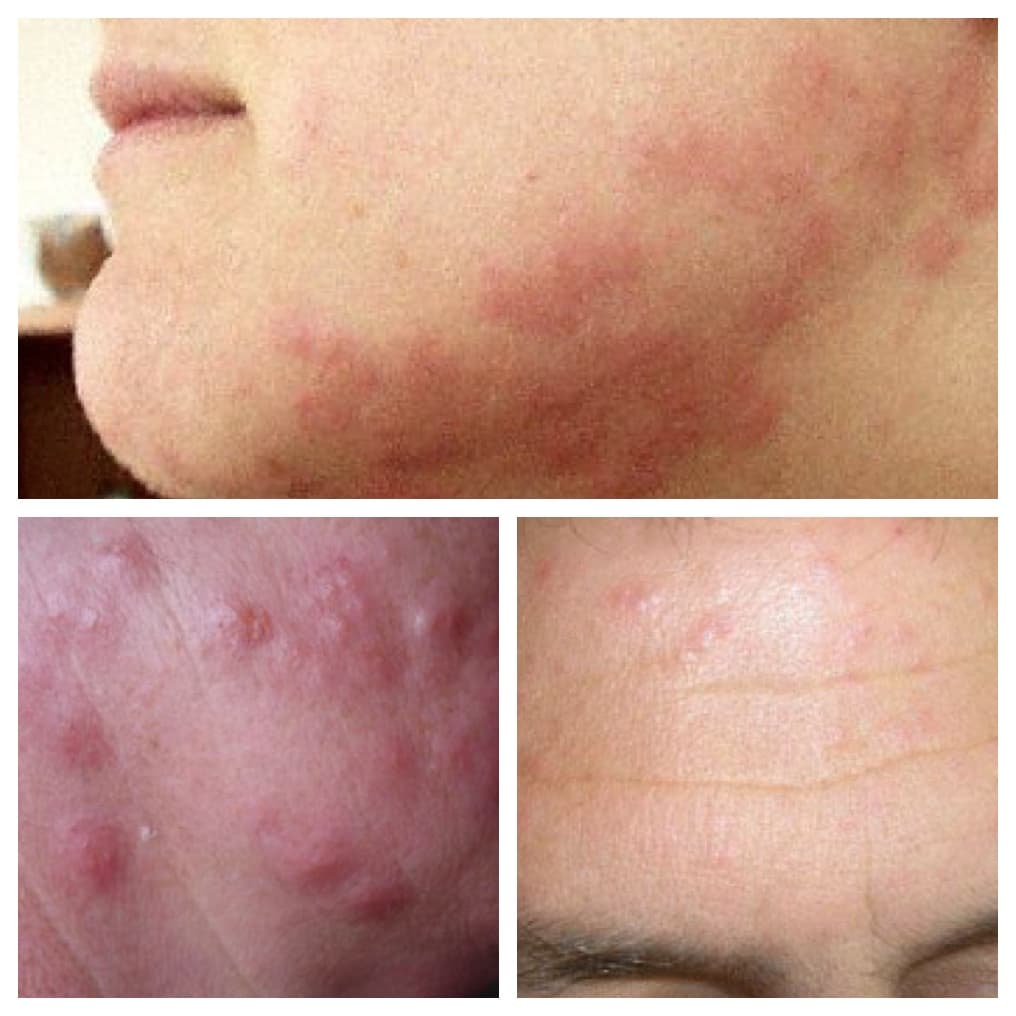 Bed Bug Bites on Neck and Forehead