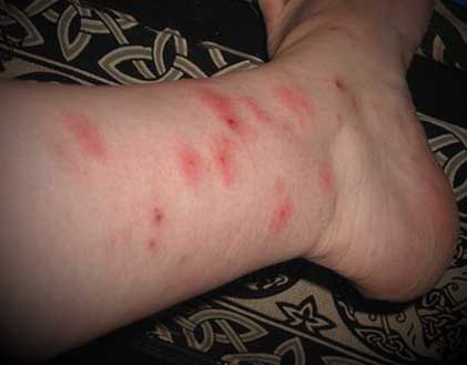 bed bug bites on lower leg