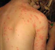 hundreds of bed bug bites on skin