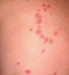 bed bug bite pattern on skin