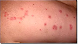 Picture Bed Bug Bites