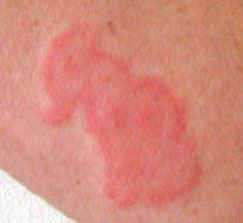 bed bug rash on arm