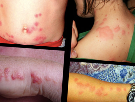4 bed bug skin bite examples