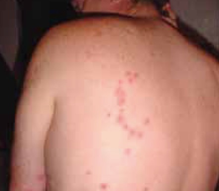 bed bug wheal rash pattern on back