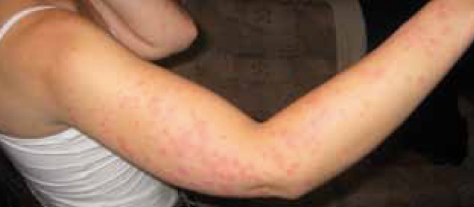 bedbug rash on arm