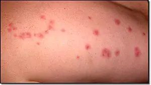 bed bug bite pattern on arm