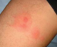 bed bug bite picture - example 3