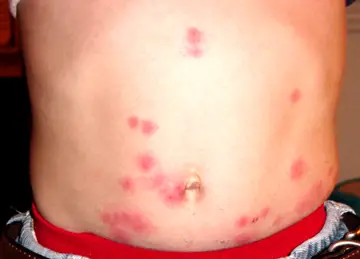 bed bug puss filled bites on stomach