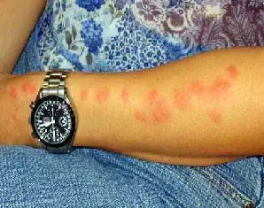 cluster of bed bug bites on arm