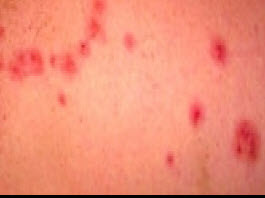 Bed bug bites on arm - example 1