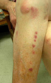 bed bug bites in row on leg