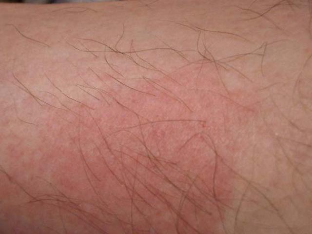 bed bug bite skin rash 48 hours after bite