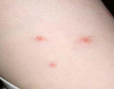 bed bug bugs bites bite skin stages actual handbook