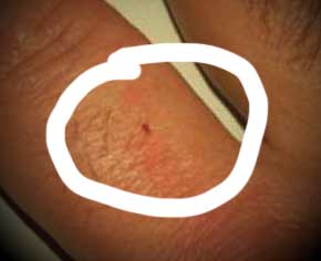 Show Me Pictures Of Bed Bug Bites
