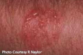 bed bug bite skin reaction rash