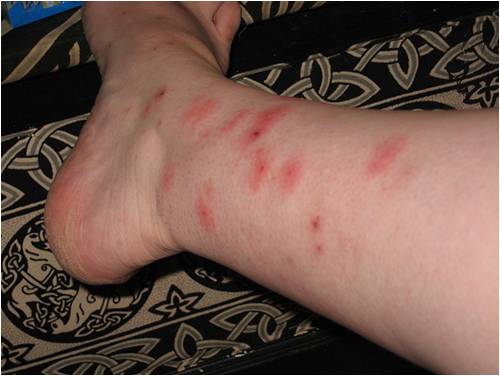 multiple bed bug bite marks on lower leg