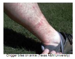 chigger bites on leg