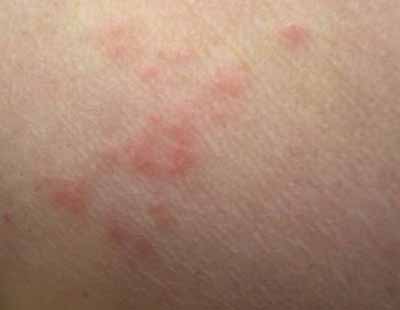 Bed bug bites (one hour after bite) on skin