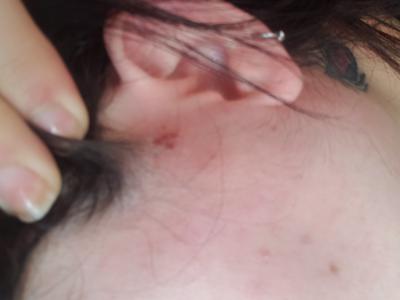 Insect Bites Next to Ear