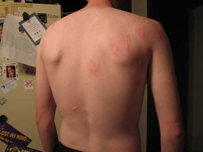 Picure Mosquito bites on lower back - example 2