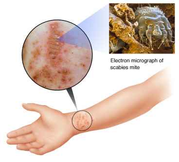scabies bite on arm