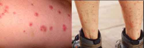 bed bug bite picture compared to mosquito bites