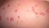 Bed bug bites on arm. Multiple bed bugs will cause bites in multiple areas on the body.