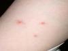 Bed bug bites like these are an allergic reaction. Some people show no reaction while others can get pimples, bumps or even blisters on the arm.