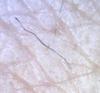 Possible Case of Morgellons