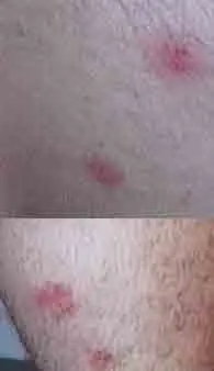 bed bug bites on arm