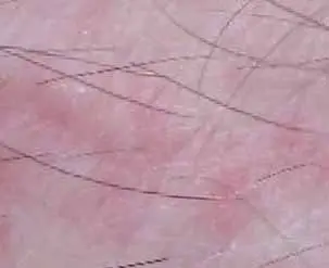 picture of bed bug bites